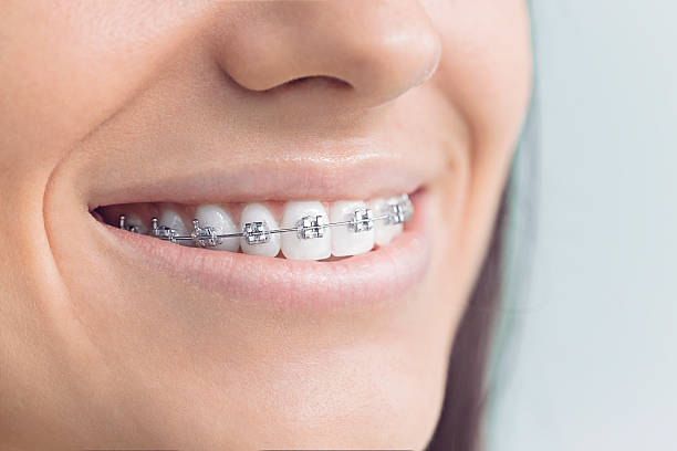 Best Veneers and Lumineers  in Fort Myers Shores, FL